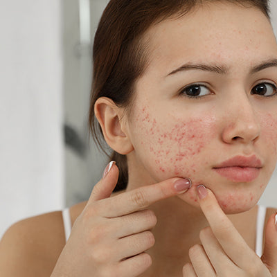 Types Of Acne, Their Causes, Ayurvedic Remedies & Diet To Follow
