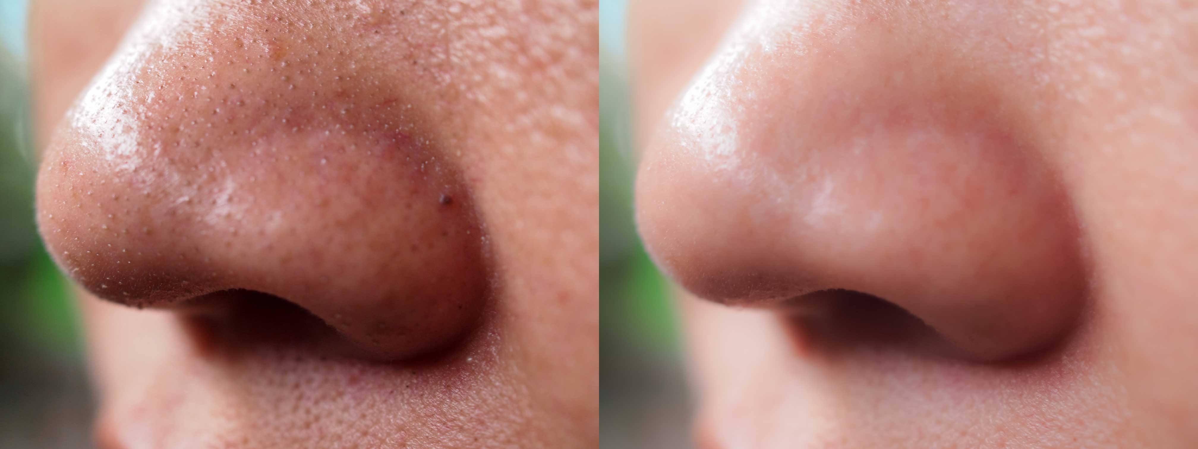Your Nose Pores With Natural Remes