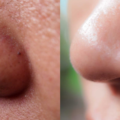 How To Clean Your Nose Pores With Natural Remedies?