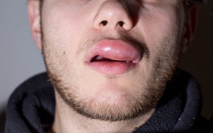 Swollen Lips: Causes, Symptoms & Treatments – Vedix