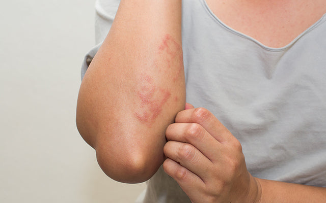 Skin Infections: Types, Symptoms, Treatment & Prevention