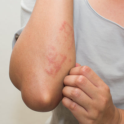 Skin Infections: Types, Symptoms, Treatment & Prevention