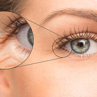 Under Eye Wrinkles: Causes, Prevention & Treatment