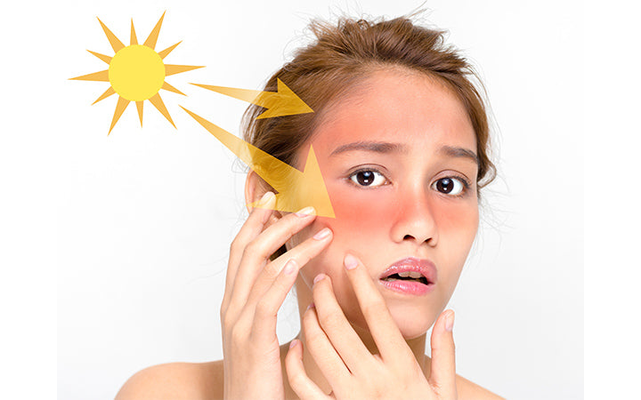 Sunburn On Face: Causes, Symptoms, Treatments & Preventive Tips