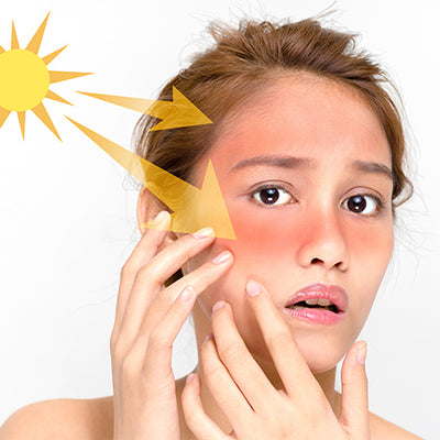 Sunburn On Face: Causes, Symptoms, Treatments & Preventive Tips