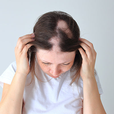 All You Need To Know About Alopecia Areata