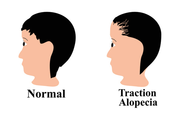 How To Prevent Traction Alopecia Before It’s Too Late?