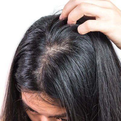 Oily & Greasy Scalp? Try These Holistic Ayurvedic Treatments!