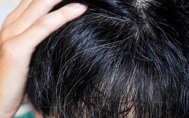 Grey hair: Causes, Symptoms, Treatment, Prevention, Remedies and Solution