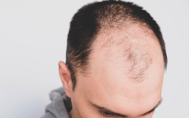 What Is DHT Hair Loss And How Is It Treated In Ayurveda?