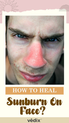Remedies For Sunburn On Face