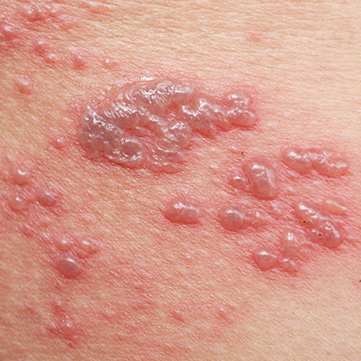 Common Skin Lesions: Types, Causes, Symptoms & Treatments