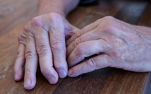 How To Treat Psoriatic Arthritis Naturally?