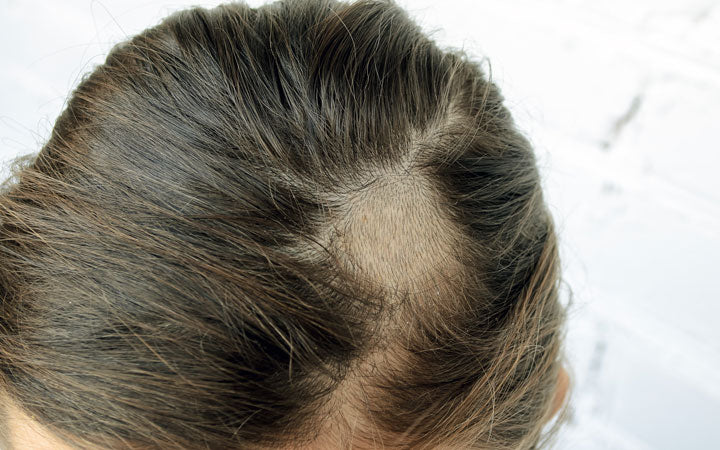 Tinea Capitis - How Can Ayurveda Treat Your Scalp Condition? – Vedix