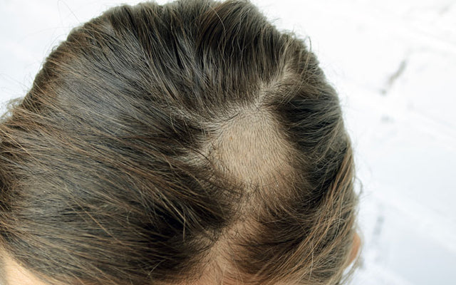 Hair loss treatment Antifungal medicine could really work if you have  ringworm  Expresscouk