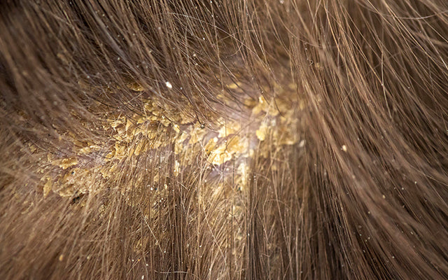 Scabs On The Scalp: Causes, Symptoms & Treatments