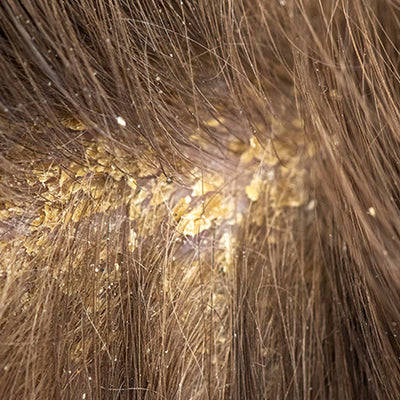 Scabs On The Scalp: Causes, Symptoms & Treatments
