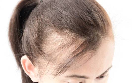 femalep pattern baldness