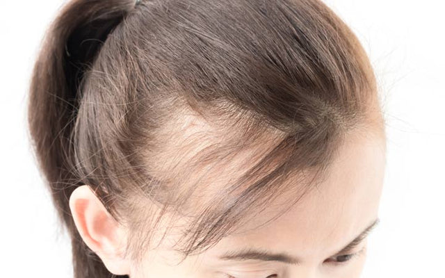 Ayurvedische Methoden zur Behandlung von weiblichem Haarausfall – Vedix