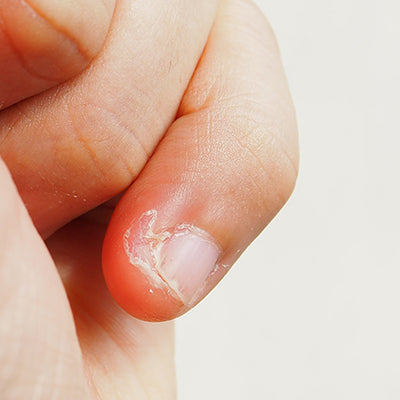 How To Prevent & Treat Skin Peeling Around Nails?