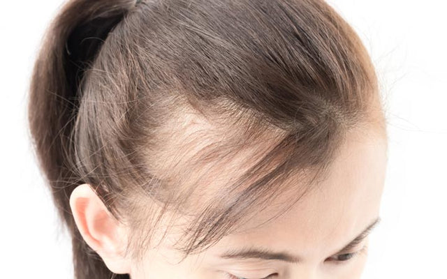Receding Hairline Treatments According To Ayurveda