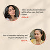Prakhya Acne Rescue Regimen With Serum & Face Wash