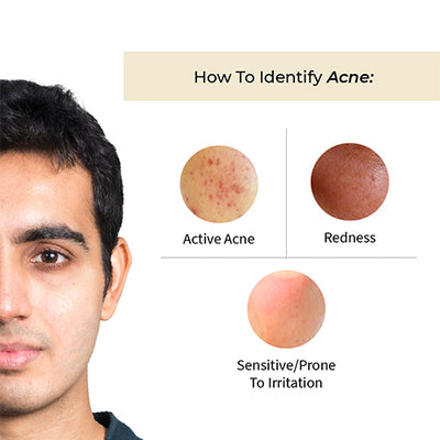 Prakhya Acne Rescue Face Serum For Men